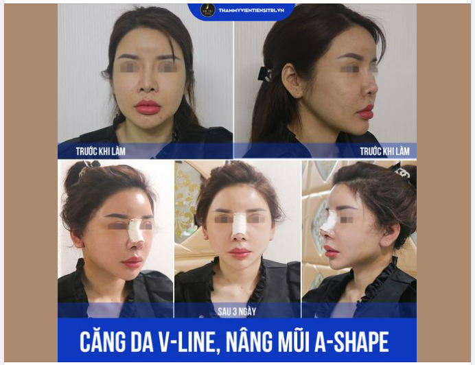 HÌNH ẢNH TÁI KHÁM 3 NGÀY CĂNG DA V-LINE, NÂNG MŨI A-SHAPE