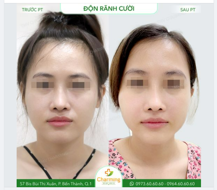 Bạn đang ở thời kỳ tươi trẻ của cuộc đời nhưng rãnh cười lại không cho bạn tận hưởng sự thanh xuân trên khuôn mặt.
