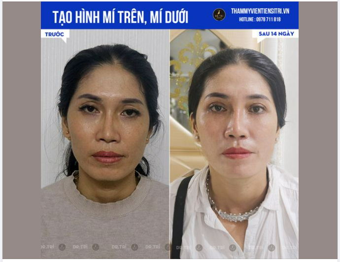 MÍ HƯ - MÍ LỖI ĐÃ CÓ GIẢI PHÁP!!