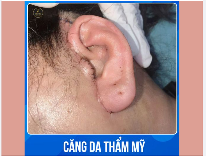 HÉ LỘ CĂNG DA VLINE GIẤU SẸO SAU 3 NGÀY