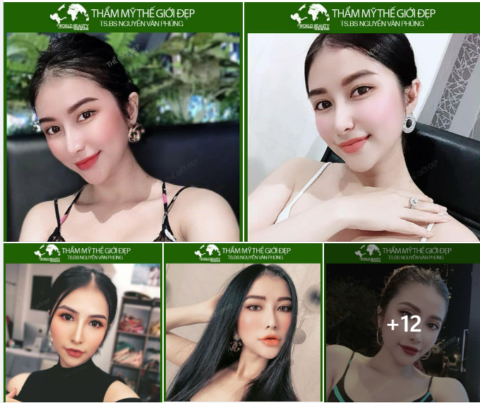 Sau 5 năm n.âng cấp nhan sắc bằng giải pháp N.âng mũi cấu trúc tại Thế Giới Đẹp, nữ 9X Việt kiều Mỹ vô cùng hài lòng về kết quả: