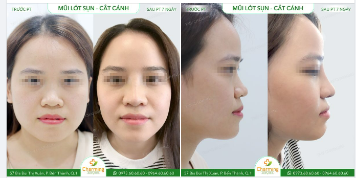 Nếu chỉ nhìn từ phía trước, chúng ta dễ lầm tưởng là chóp mũi của bạn to nên khiến mũi thô.