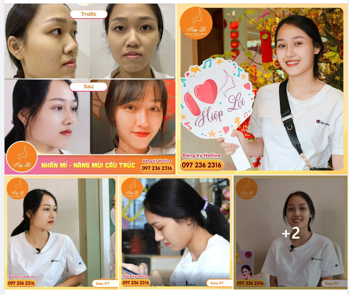 COMBO NÂNG MŨI CẮT MÍ - HOÀN THIỆN NHAN SẮC NHƯ MƠ