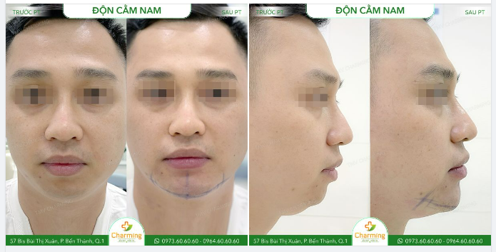Nhìn ảnh chụp trực diện của bạn nam này, chị bạn ngồi cạnh Charming bảo "Ủa bạn này có cằm mà em, sao phải độn?