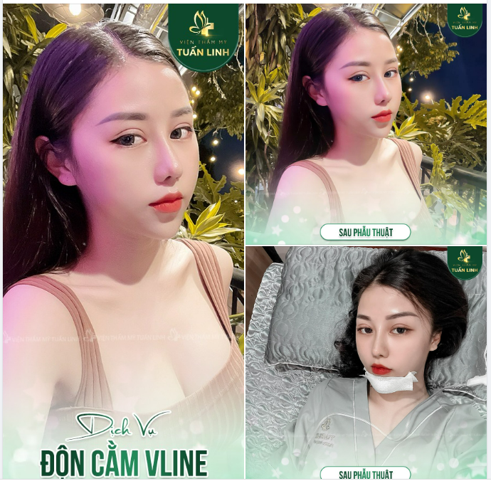 Thực hiện nhanh chóng 30 phút độn cằm - hết ngắn/lẹm/miệng hô - xinh sang hơn gấp bội! ​​​​​​​Chỉ từ 15TR - Hỗ trợ trả góp 0% lãi.