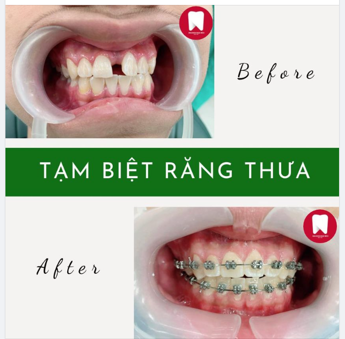 KHÔNG CÒN KHOẢNG TRỐNG, BỪNG SÁNG TỰ TIN VỚI RĂNG SỨ THẨM MỸ