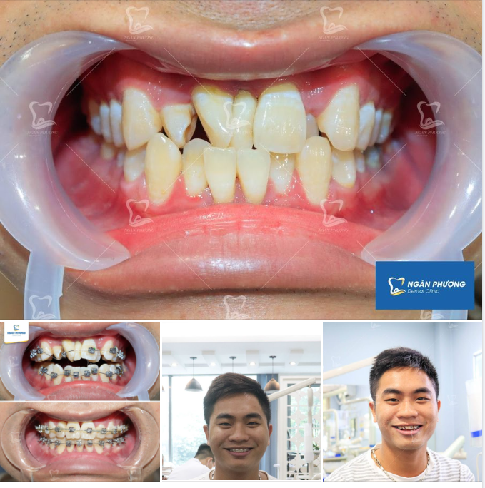 Thần kỳ! Răng trăm ngả nay đã quy về một mối