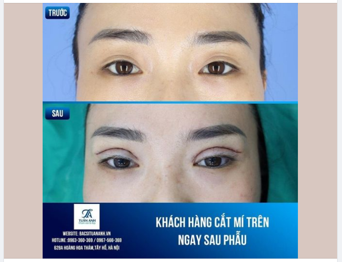 NGAY SAU PHẪU THUẬT MÍ TRÊN ĐÃ ĐƯỢC ĐỊNH HÌNH