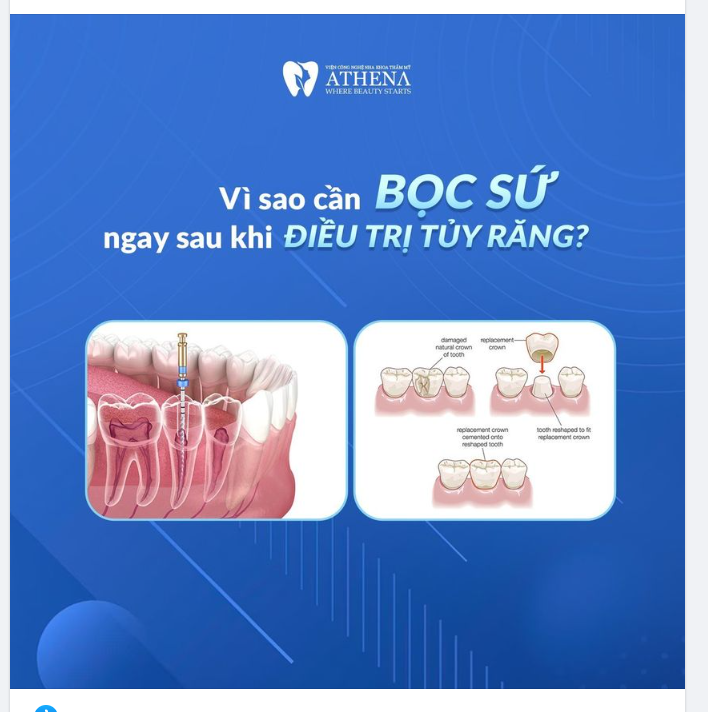 BẠN CẦN BỌC SỨ NGAY SAU KHI ĐIỀU TRỊ TỦY RĂNG NẾU KHÔNG SẼ RẤT NGUY HIỂM, TẠI SAO LẠI VẬY?