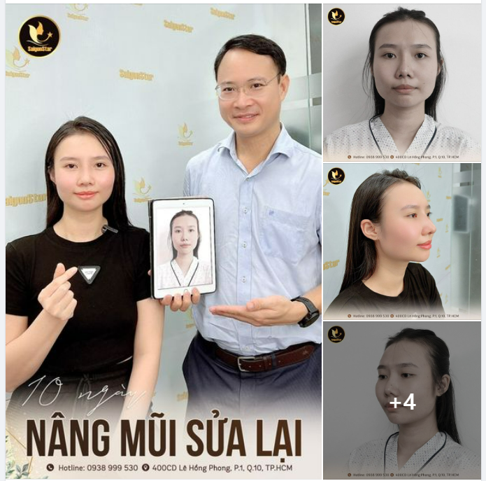 10 NGÀY NÂNG MŨI SỬA LẠI ĐẸP TRỌN GÓC NHÌN