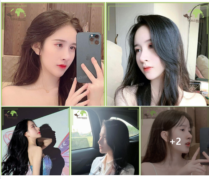  Chỉ sau ph.ẫu thuật nâng mũi cấu trúc bằng sụn tự thân kết hợp thanh Surgiform tại Thế Giới Đẹp!