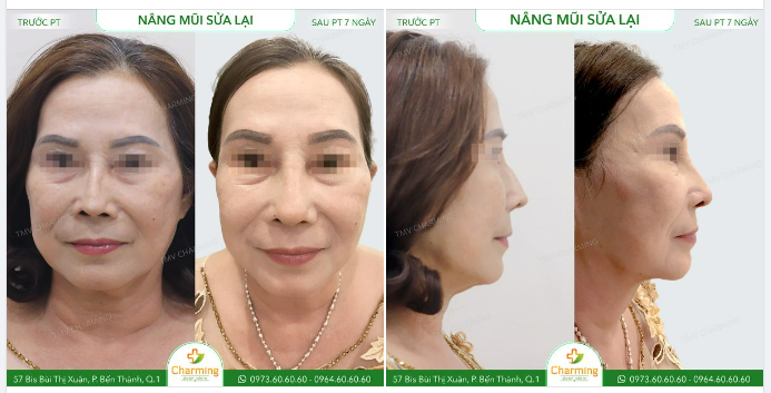 Trường hợp của cô khách nâng mũi đã lâu, nhưng không biết thế nào mà mũi bị lộ sóng, lệch và trông như thể muốn bung ra vậy.