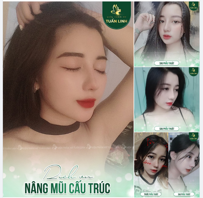 Khách hàng 9X xinh đẹp rạng ngời với dáng mũi cấu trúc nâng tại Tuấn Linh!!