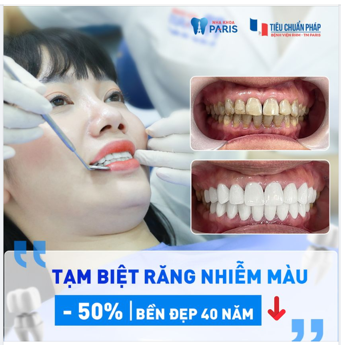 TẠM BIỆT RĂNG NHIỄM MÀU -50% LÀM RĂNG SỨ THẨM MỸ