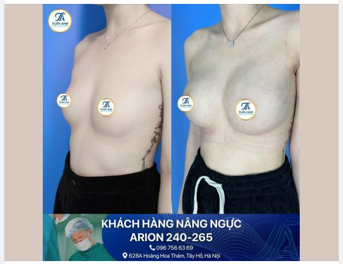 BỎNG MẮT VỚI ‘CẶP LOA’ SAU KHI NÂNG CẤP