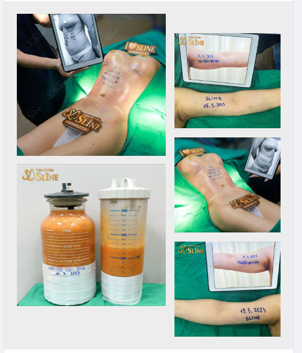 THÁNG CỦA NHỮNG COMBO ĐẠI PHẪU SIÊU KHỦNG