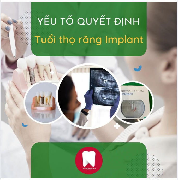 YẾU TỐ QUYẾT ĐỊNH TUỔI THỌ CỦA RĂNG IMPLANT