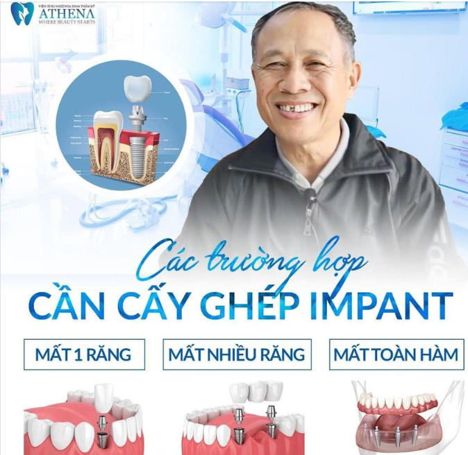 CÁC TRƯỜNG HỢP NÊN CẤY GHÉP IMPLANT