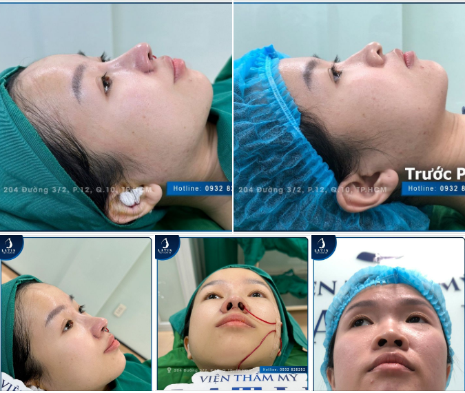 Mũi cấu trúc cho em gái​​​​​​​ Đẹp ngay sau khi làm