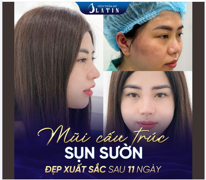 MŨI CẤU TRÚC SỤN SƯỜN 11 NGÀY