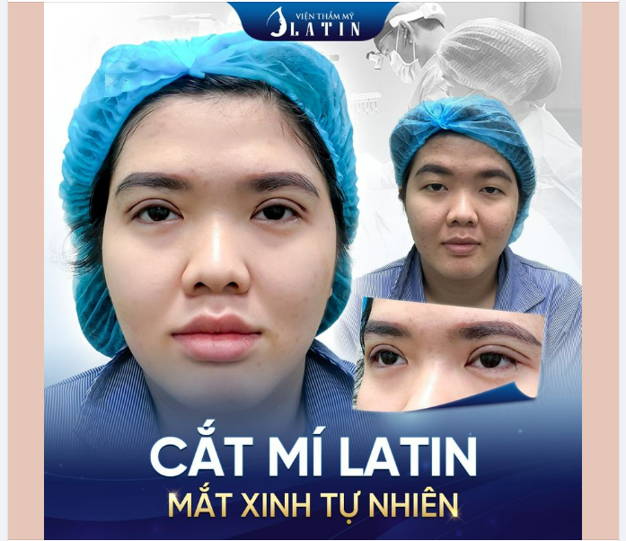 Mắt một mí khiến khách vô cùng tự ti và là nỗi ám ảnh từ nhỏ đến lớn. Đi đâu cũng bị chê cười vì đôi mắt nhỏ và khiến cho khuôn mặt thiếu thiện cảm.