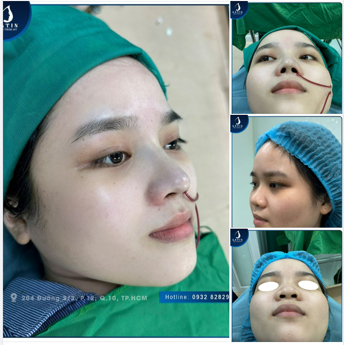 Hoàn thành ca mũi bán cấu trúc cho em gái thích dáng cao tự nhiên, hợp mặt