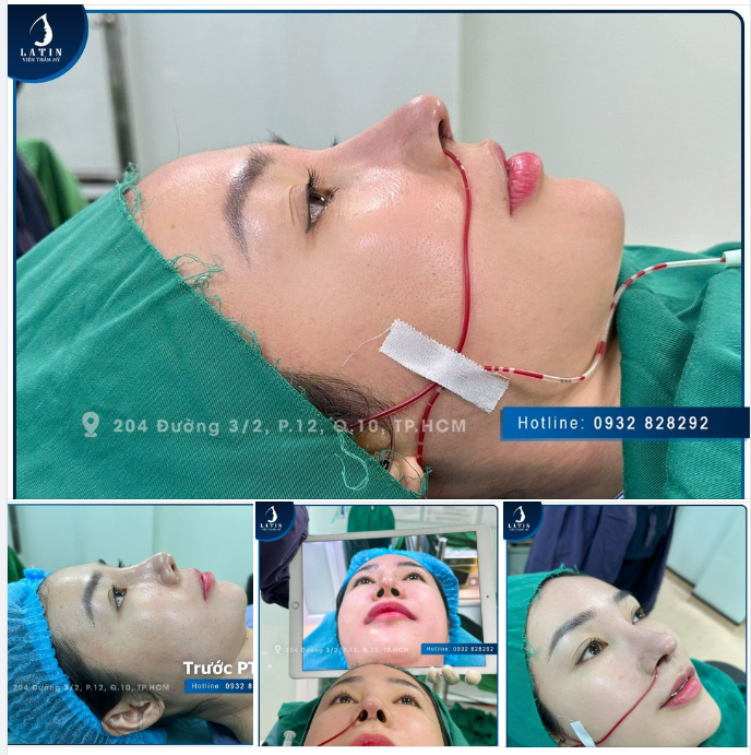 Stress vì mũi đã nâng nhưng không thành công, chị khách quyết tâm đến Latin để tìm được dáng mũi như ý.