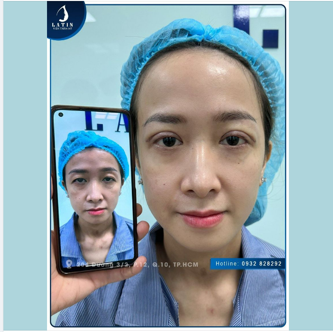 CHIA TAY MÍ SỤP, SỞ HỮU MẮT 2 MÍ ĐẸP NHƯ MONG ƯỚC