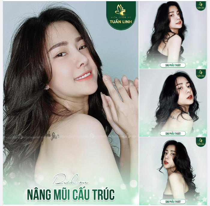 Sở hữu khuôn mặt cá tính, trẻ trung, xinh đẹp sau nâng mũi cấu trúc!!