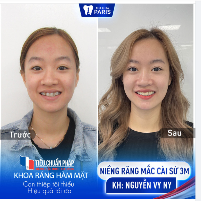 NIỀNG RĂNG MẮC CÀI SỨ - KH NGUYỄN VY NY NHAN SẮC THĂNG HẠNG SAU KHI THÁO NIỀNG