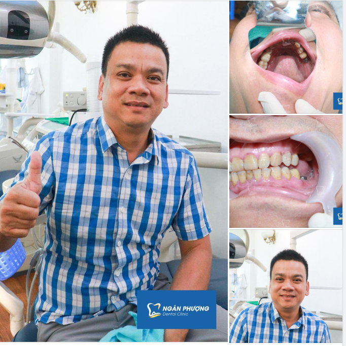 Mất răng chẳng lo lắng, đã có cấy ghép Implant