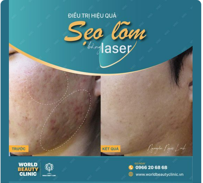 ĐIỀU TRỊ SẸO RỖ HẬU QUẢ DO MỤN