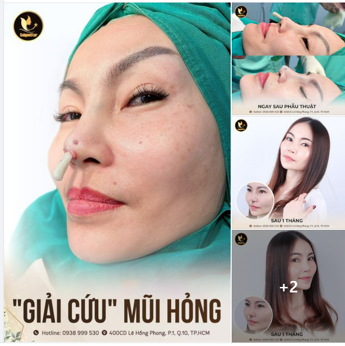 SỐC!!! SỤN ĐÂM THỦNG ĐẦU MŨI  BÁC SĨ HOẠT DÙNG HẾT 15 NĂM KINH NGHIỆM GIẢI CỨU