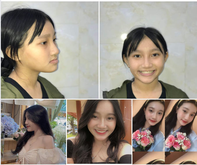 Hai năm sau khi tháo mắc cài vẫn chưa hề hối hận về quyết định niềng răng của mình.