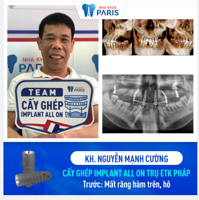 KHÁCH HÀNG CẤY TRỤ IMPLANT ETK HOÀN HÀM
