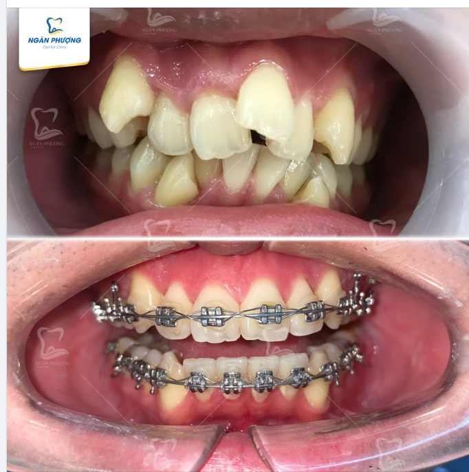 Hỏi đáp về niềng răng khấp khểnh