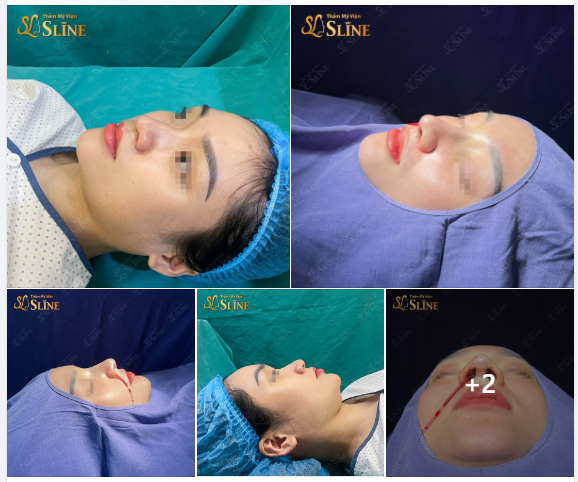 30 PHÚT NÂNG MŨI VỚI EKIP SLINE