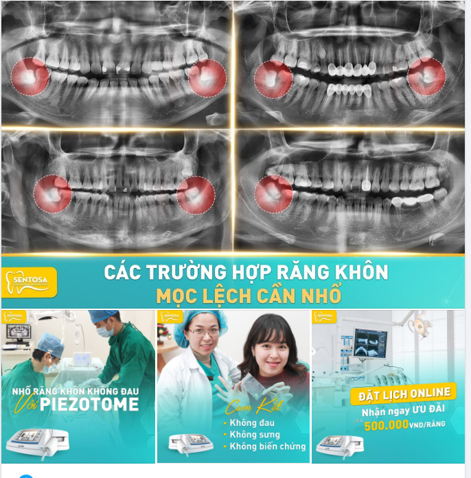 NHỔ RĂNG KHÔN MỌC LỆCH CHỈ TỪ 500.000 VND/RĂNG