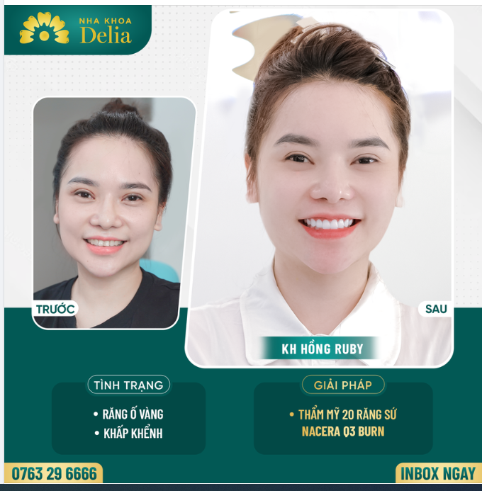 Bọc 20 răng sứ Nacera Q3 Burn - Thay đổi thần thái, tự tin khoe nụ cười mới