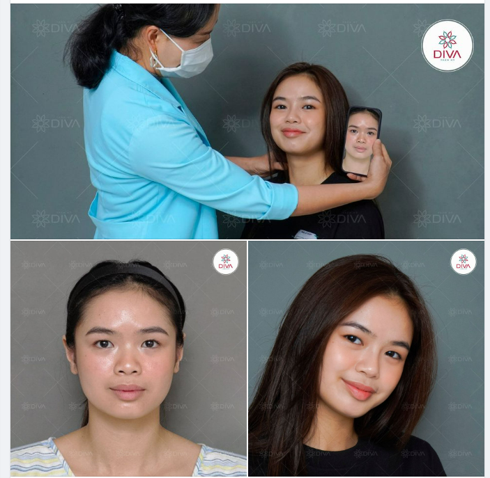 MŨI CAO TỰ NHIÊN, THU HÚT SAU 15 PHÚT NÂNG MŨI TINY POINT