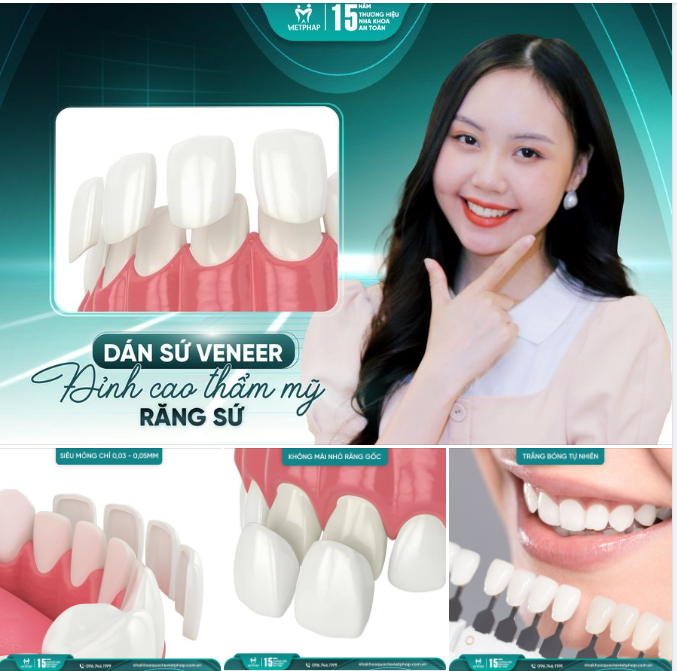 DÁN SỨ VENEER: ĐỈNH CAO THẨM MỸ RĂNG SỨ VƯỢT THỜI GIAN