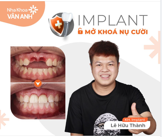 IMPLANT MỞ KHÓA NỤ CƯỜI