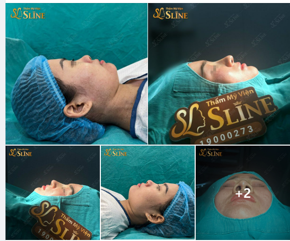 NÂNG MŨI CẤU TRÚC - SỞ HỮU DÁNG MŨI ĐẸP HOÀN HẢO