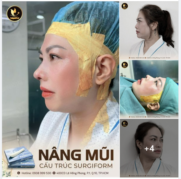 NÂNG MŨI CẤU TRÚC SURGIFORM