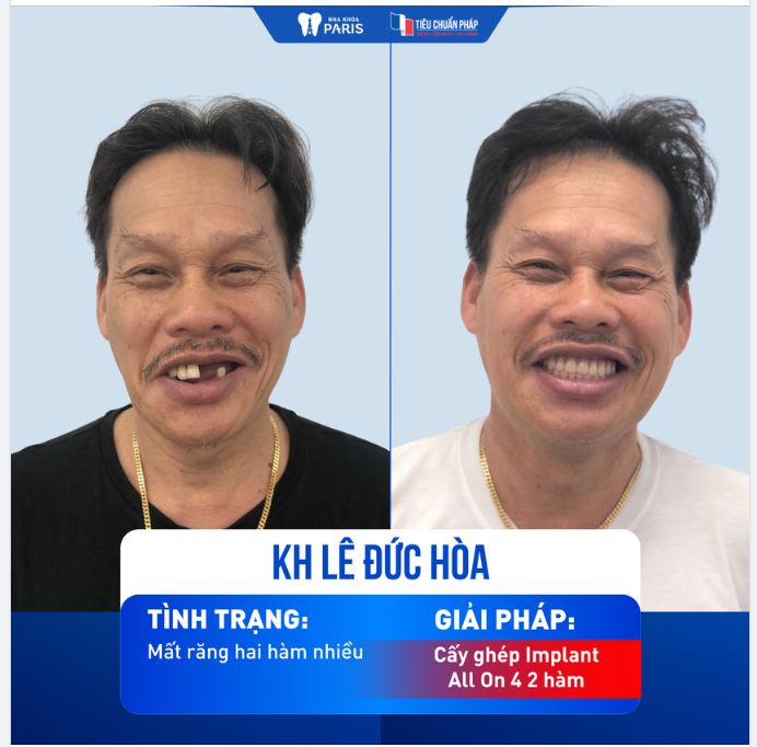 KH LÊ ĐỨC HÒA - CẤY GHÉP IMPLANT ALL ON 2 HÀM