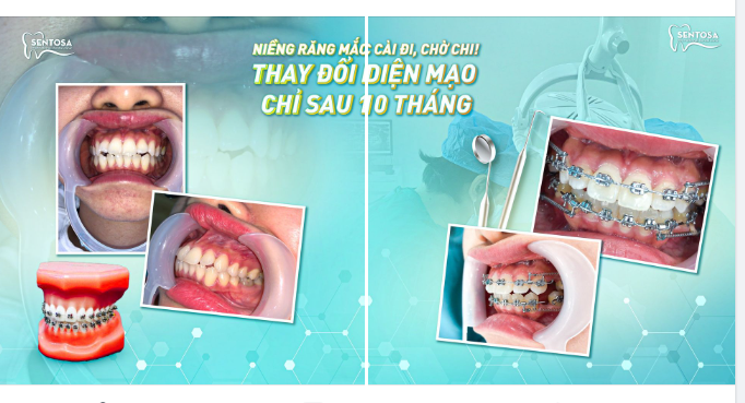 NIỀNG RĂNG MẮC CÀI ĐI, CHỜ CHI! THAY ĐỔI DIỆN MẠO CHỈ SAU 10 THÁNG