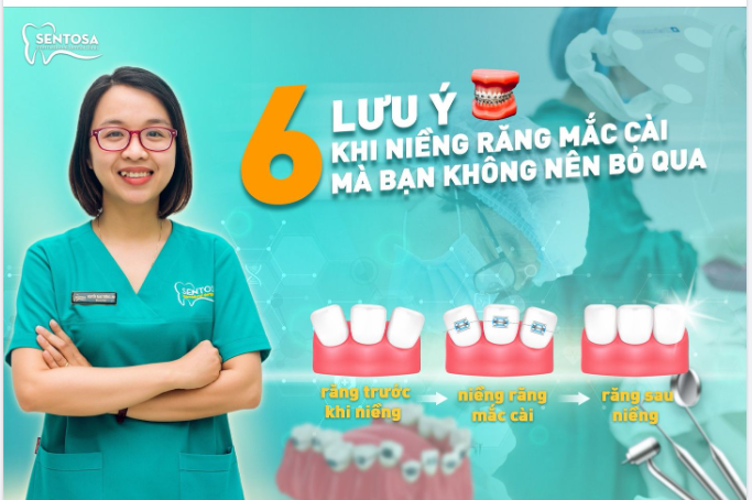 6 LƯU Ý KHI NIỀNG RĂNG MẮC CÀI MÀ BẠN KHÔNG NÊN BỎ QUA