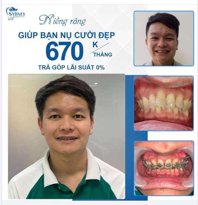 CHẤT LIỆU LÀM NIỀNG RĂNG MẮC CÀI KIM LOẠI