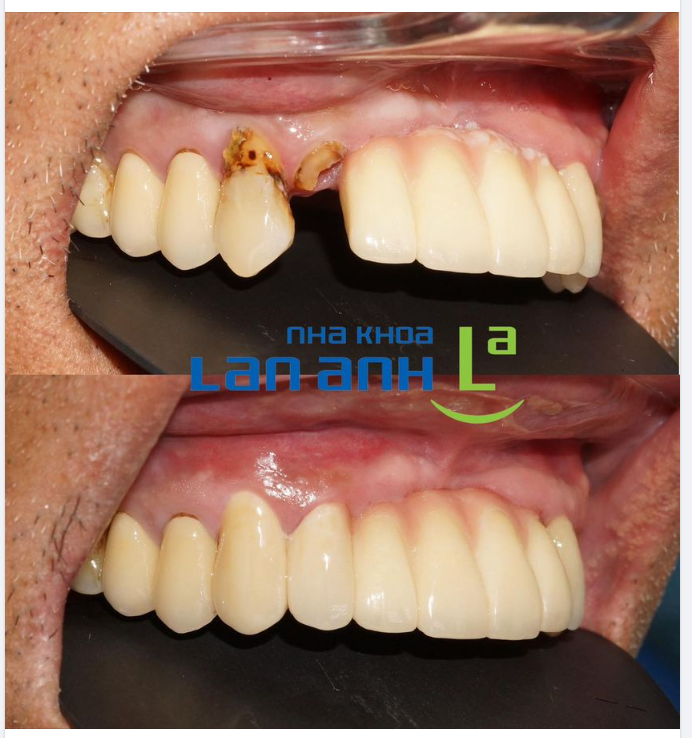 Một ca làm cầu răng của bác sĩ Tài, chi nhánh 149 Tôn Dật Tiên, Q7