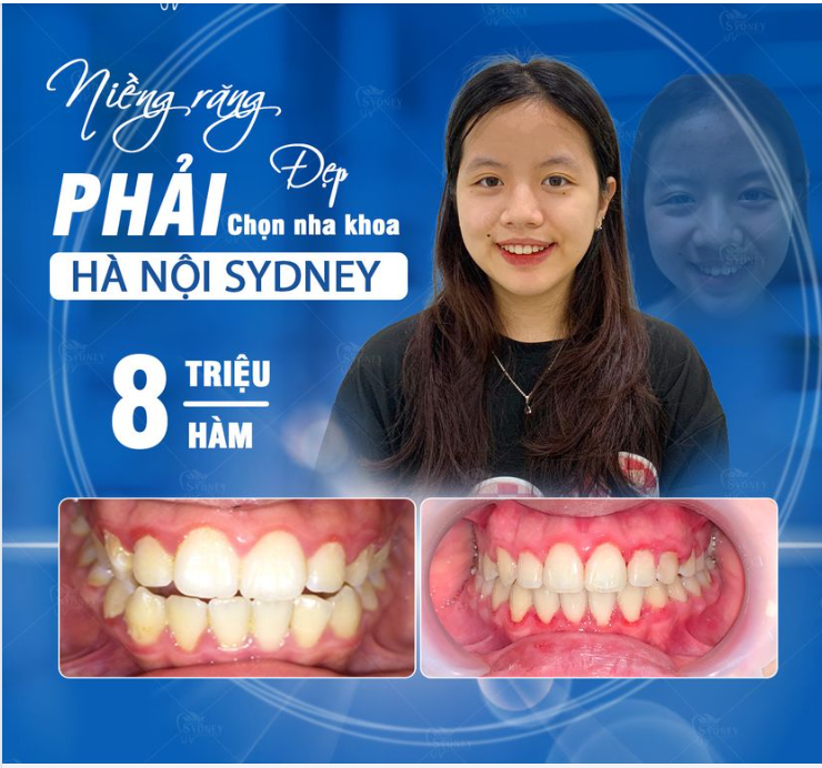 NIỀNG RĂNG Ở ĐÂU TỐT? TIÊU CHÍ LỰA CHỌN NHA KHOA UY TÍN, AN TOÀN? LƯU Ý KHI TÌM HIỂU NIỀNG RĂNG?